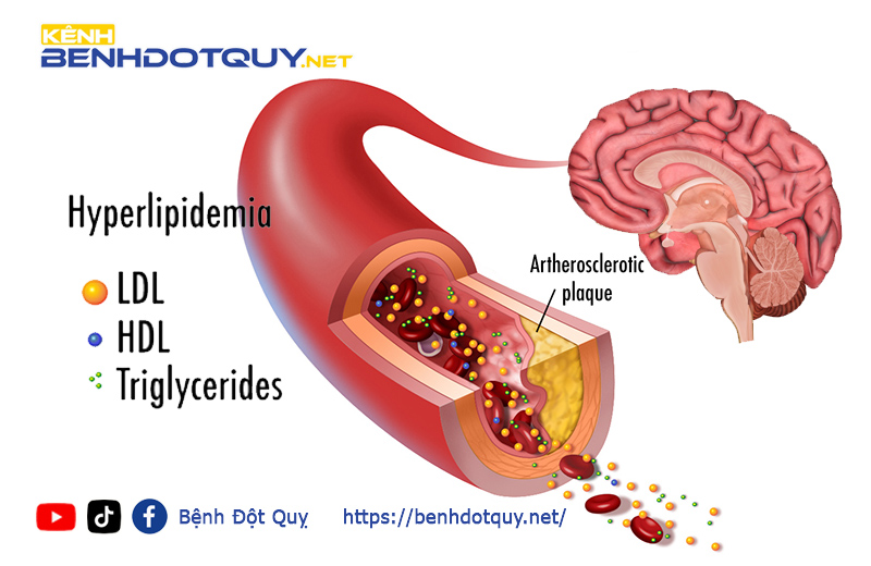 Mỡ máu cao sẽ gây ra hệ lụy gì đối với mạch máu não?