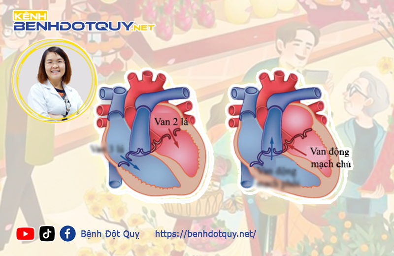 Người bệnh hẹp van 2 lá, hẹp van động mạch chủ cần làm gì để tránh nguy cơ đột quỵ?