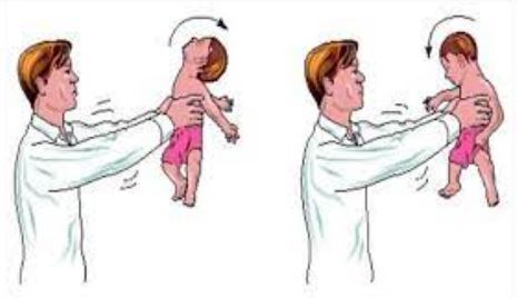 Bé 4 tháng tuổi xuất huyết não do bị bế xốc, rung lắc mạnh