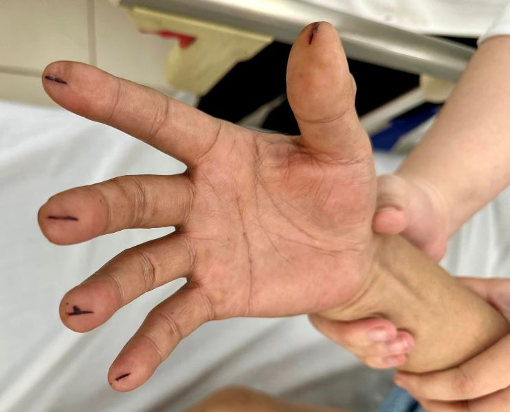 Cấp cứu đột quỵ sai cách, dùng dao lam cứa đầu ngón tay