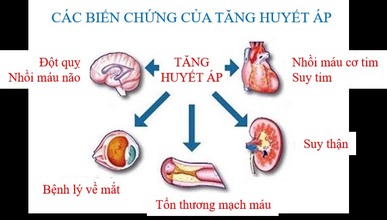 Nguy cơ bị đột quỵ do biến chứng huyết áp