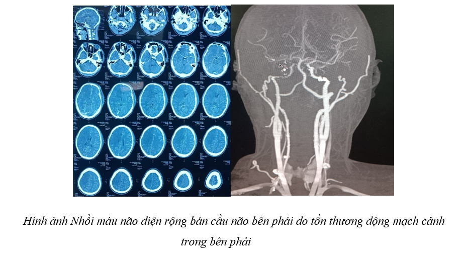 Cảnh giác tổn thương mạch máu não sau chấn thương sọ não
