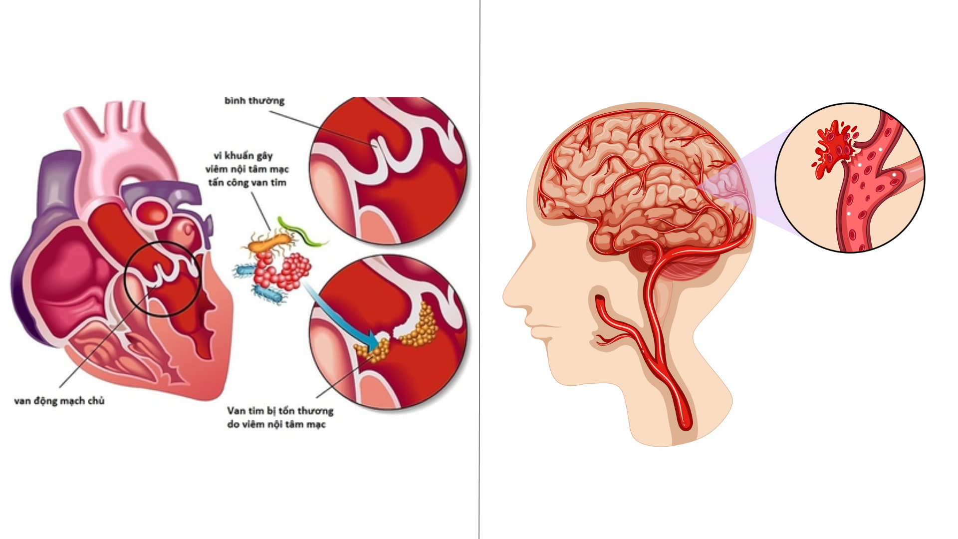 Đột quỵ khác Đột tử do tim như thế nào?