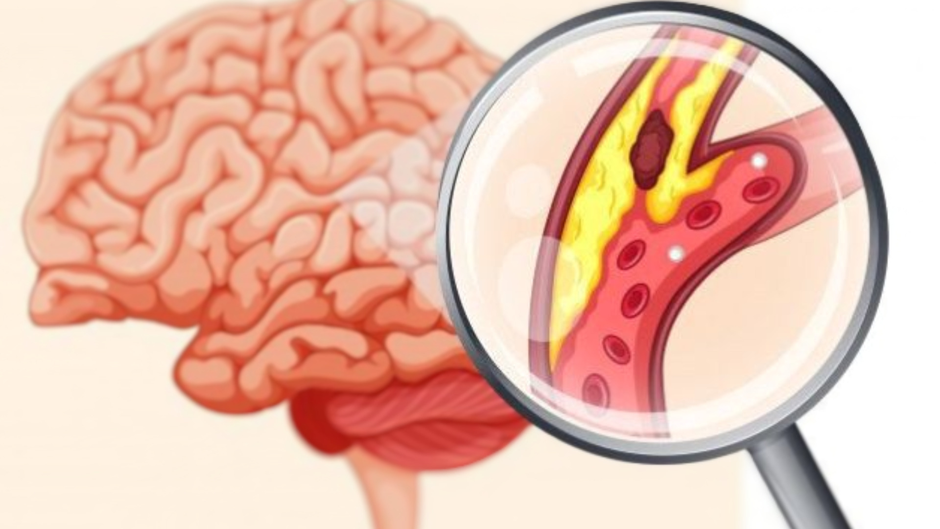 Dùng thuốc phòng ngừa đột quỵ vẫn bị nhồi máu não