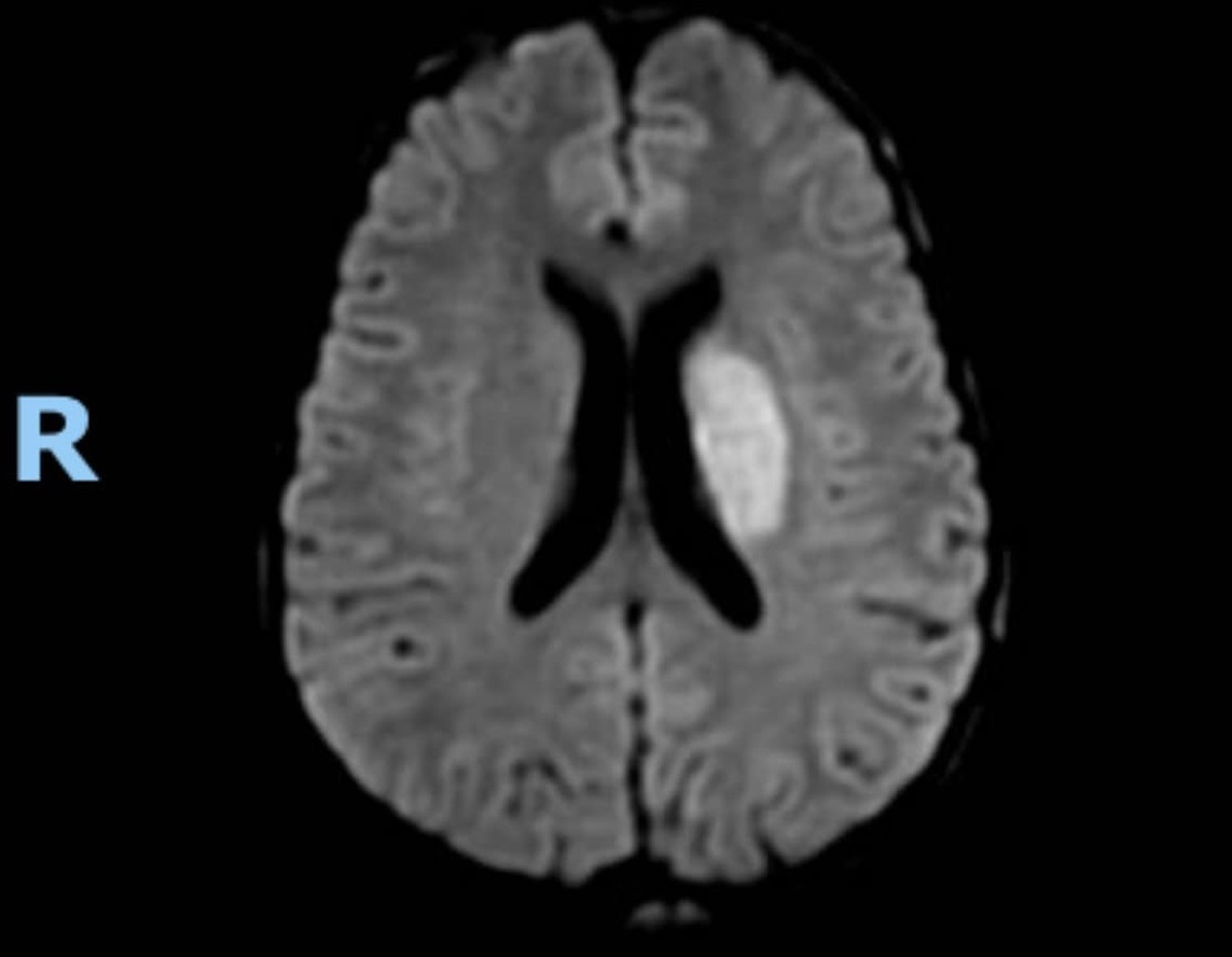 20 tuổi bị đột quỵ do sử dụng thuốc gây nghiện