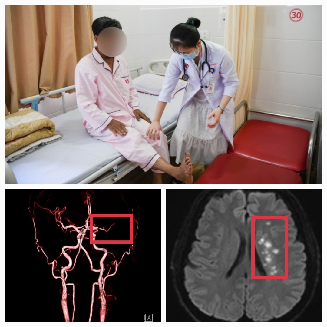 Người đàn ông đột quỵ do thói quen hút quốc lá gần 30 năm