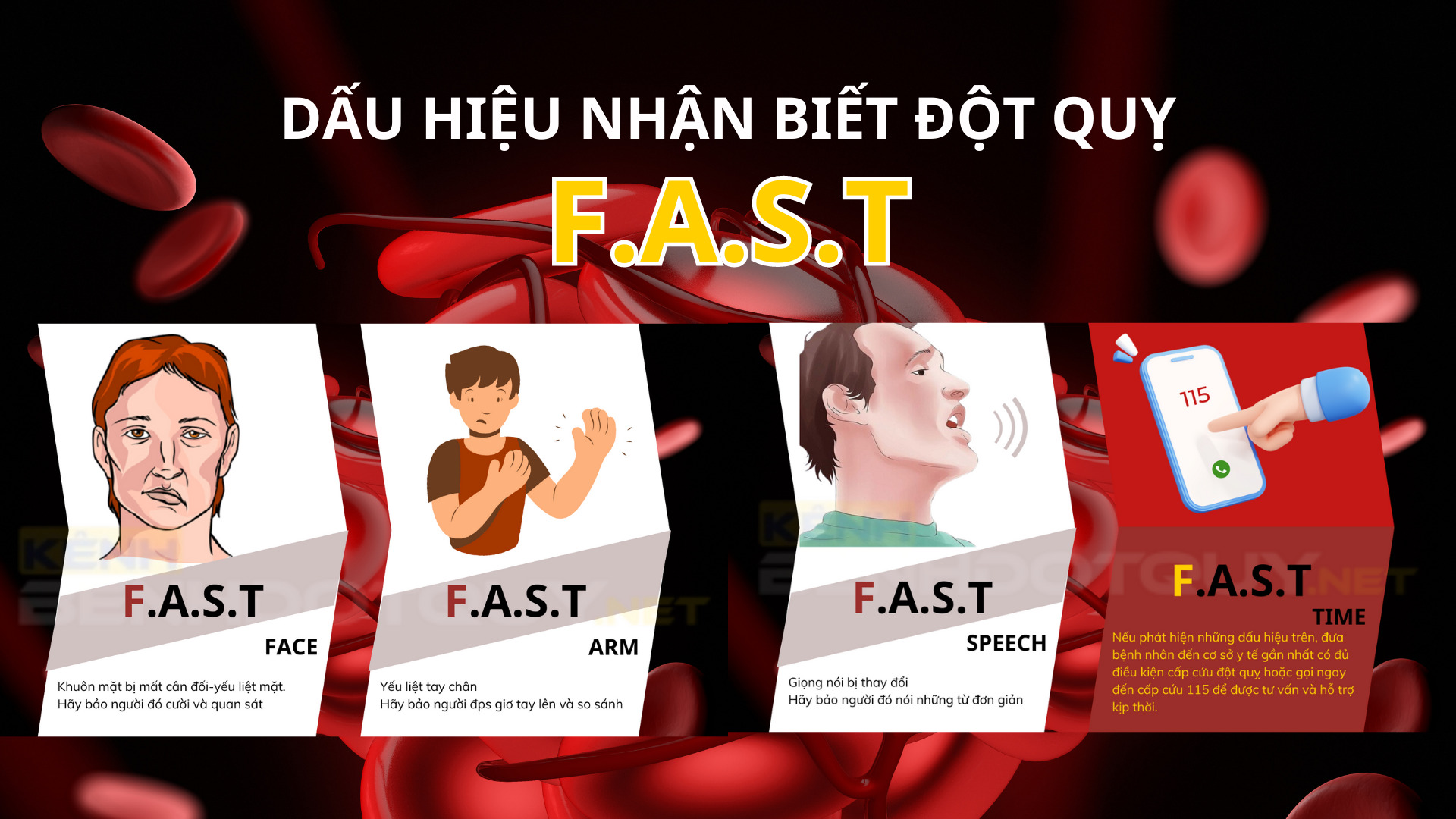 Làm thế nào để nhận biết một người bị đột quỵ?