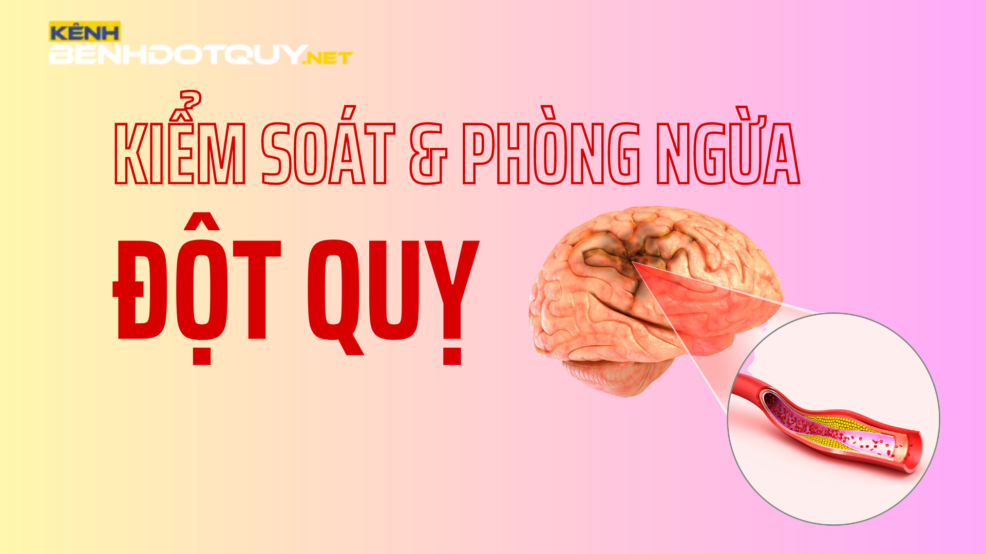 Làm thế nào để kiểm soát và phòng ngừa đột quỵ?