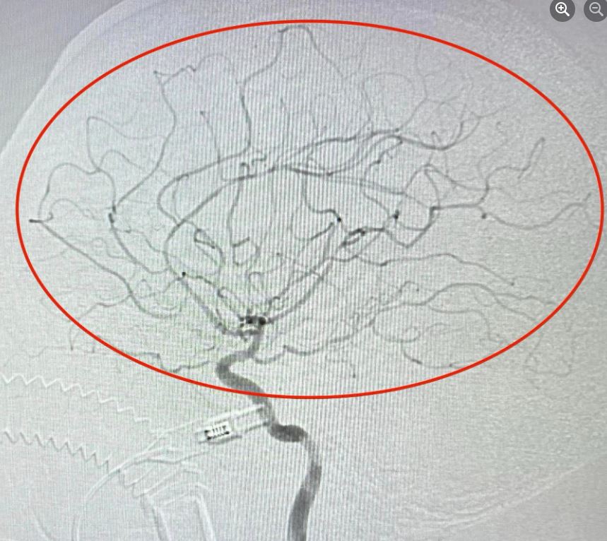Bệnh viện Thống Nhất cứu thành công cụ bà đột quỵ do tắc động mạch cảnh trong
