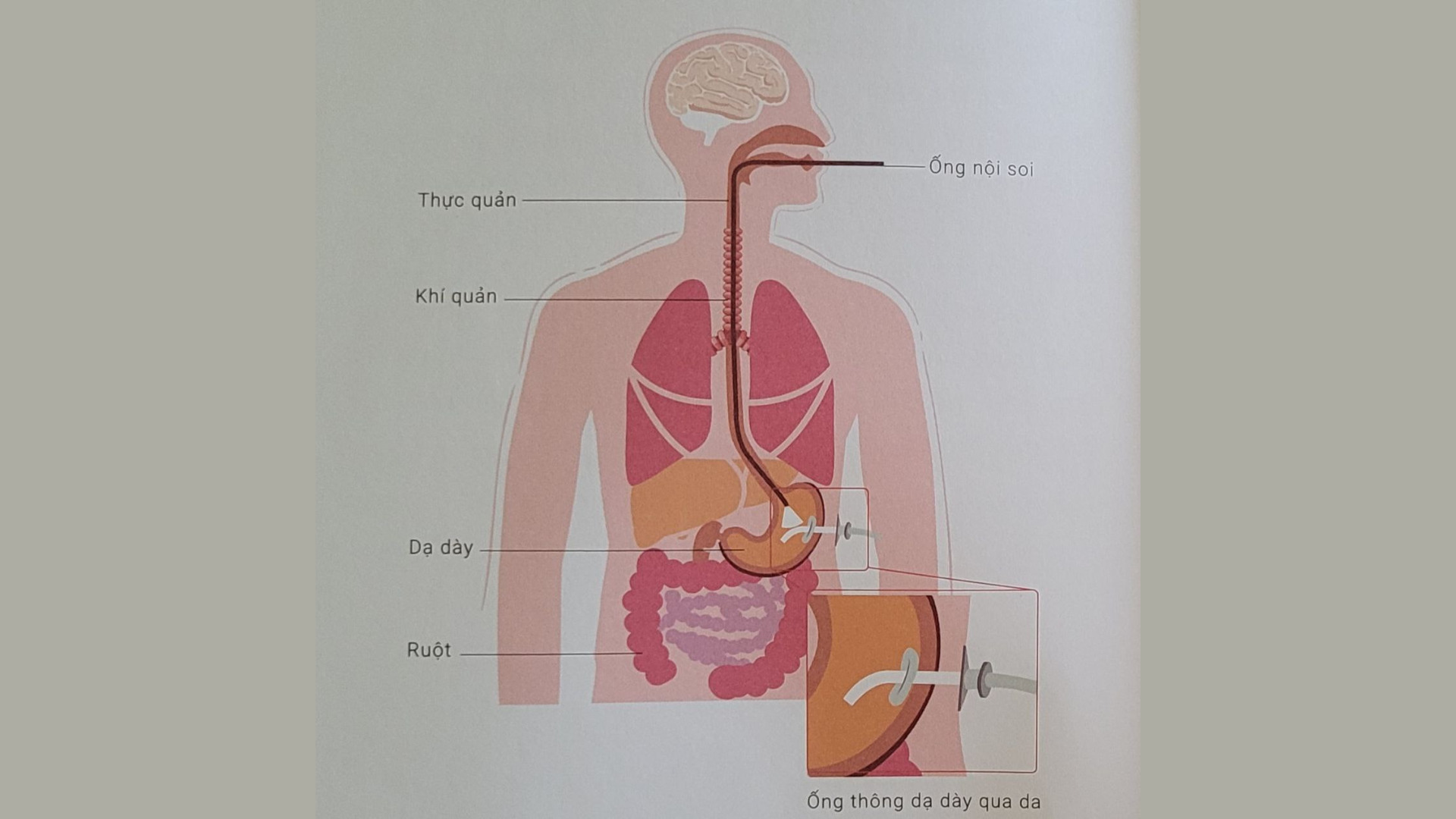 Phòng ngừa các biến chứng đột quỵ thường gặp sau đột quỵ não