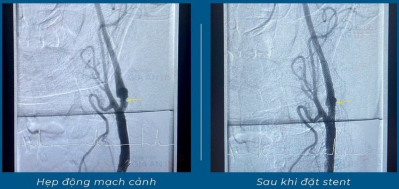 Cứu sống người đàn ông bị đột quỵ và nhồi máu cơ tim cùng lúc