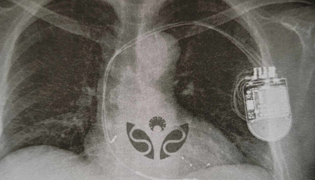 Tất cả những điều cần biết về rối loạn nhịp tim