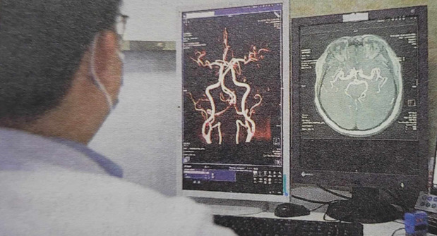 Các phương pháp chẩn đoán hình ảnh tìm nguyên nhân gây đột quỵ