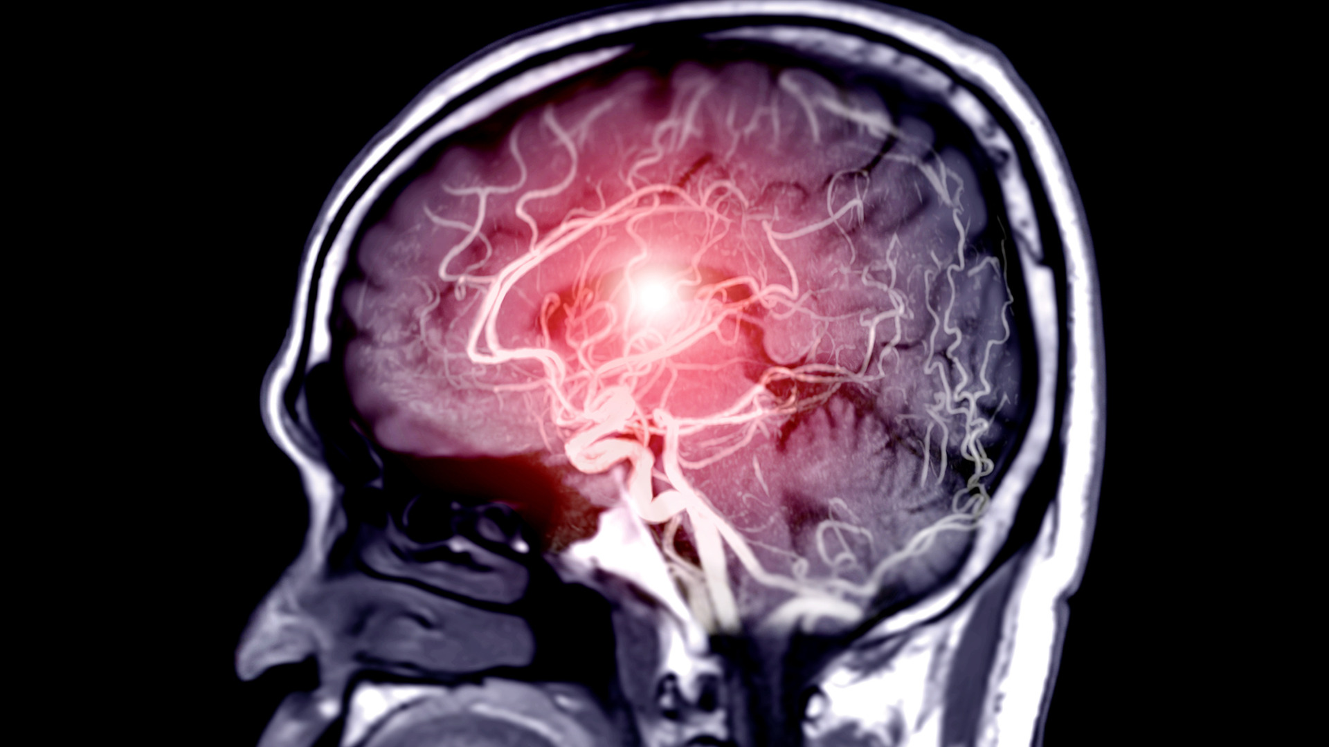 Tăng áp lực nội sọ: biến chứng của đột quỵ