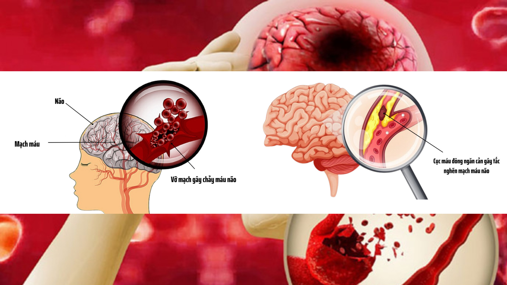 Đột quỵ não và những điều cần biết