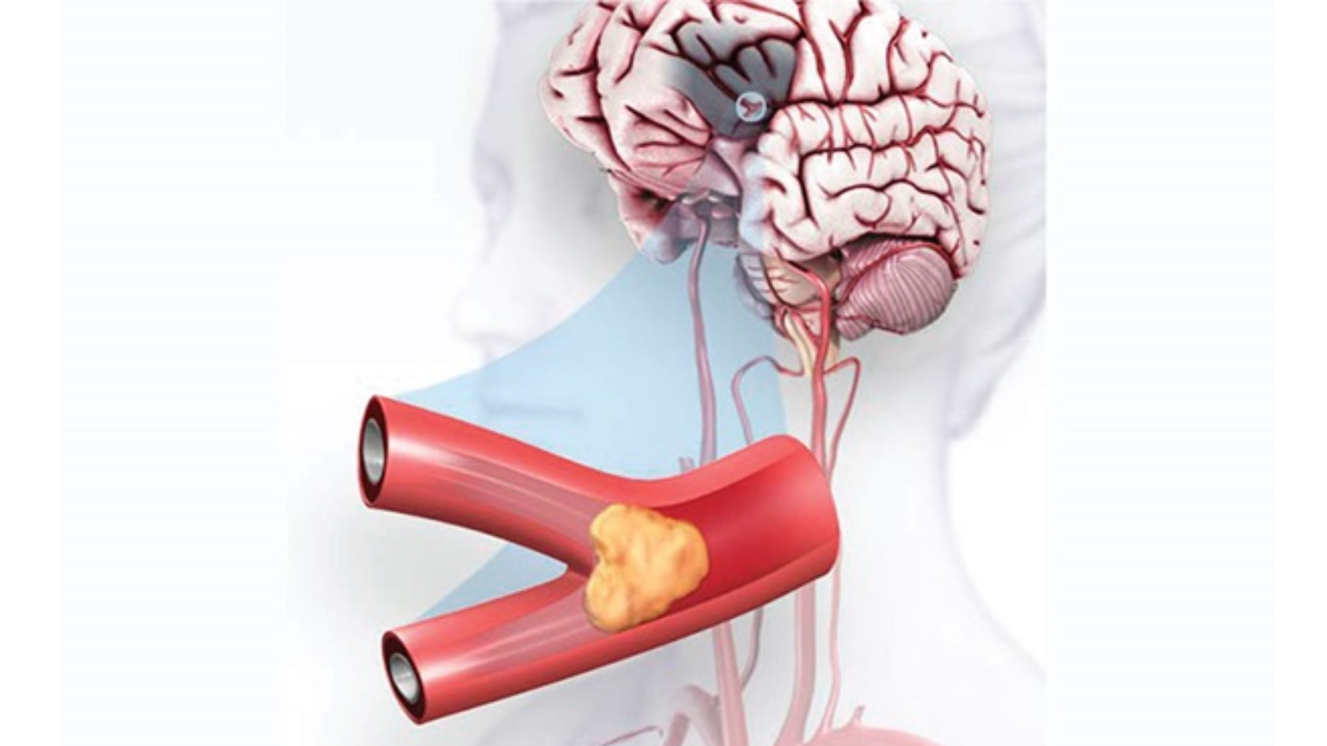 Điều trị thuốc tiêu huyết khối trong giai đoạn cấp