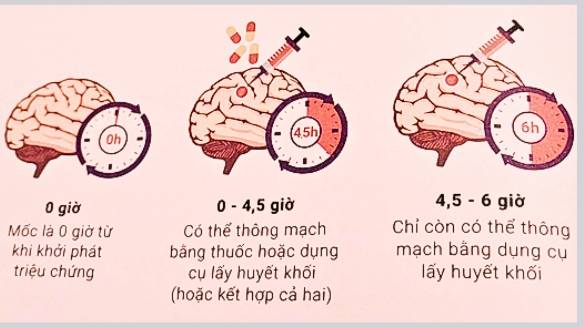 Điều trị lấy huyết khối trong đột quỵ thiếu máu não cấp