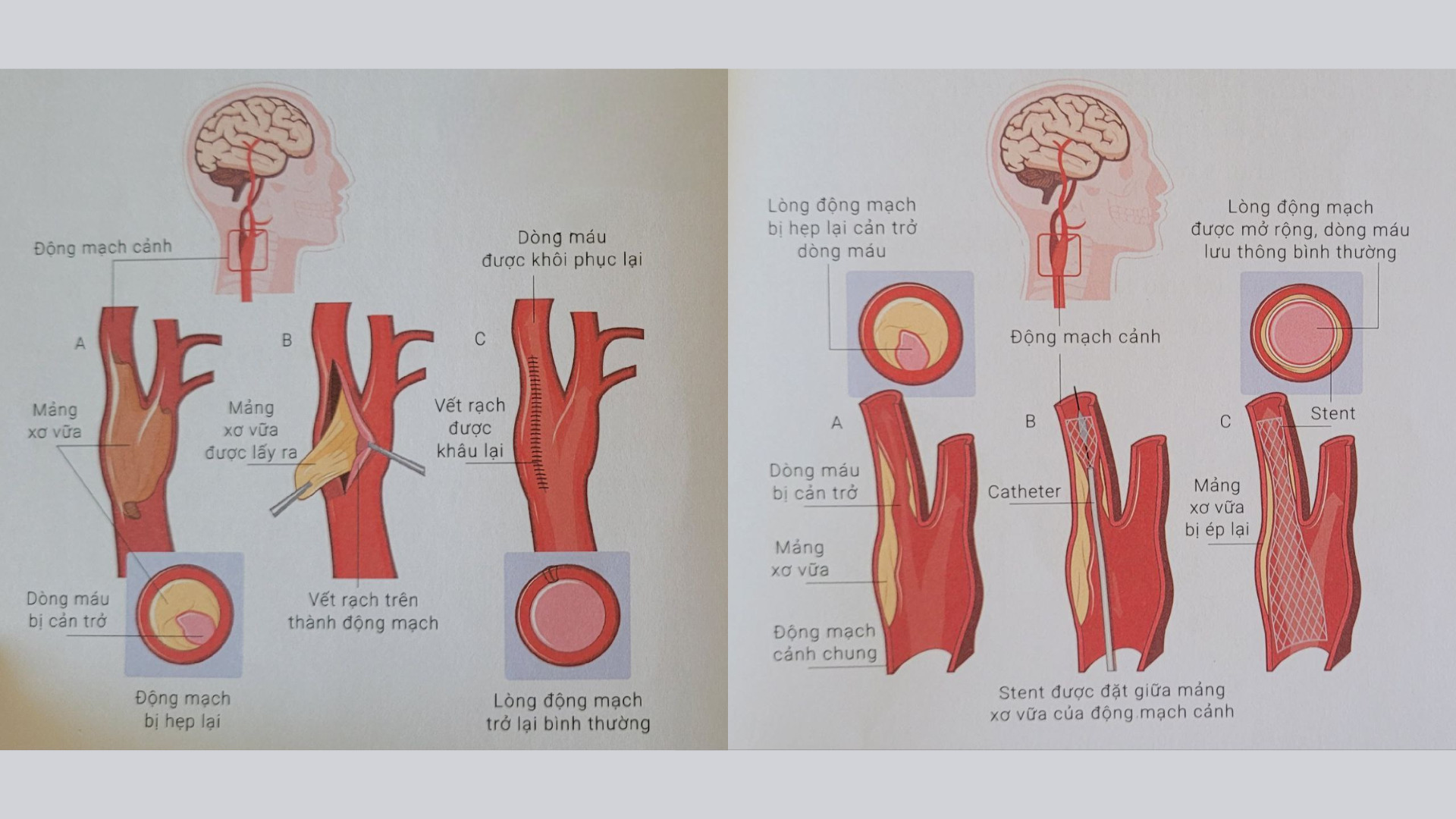 Các phương pháp điều trị khác trong điều trị Đột quỵ não