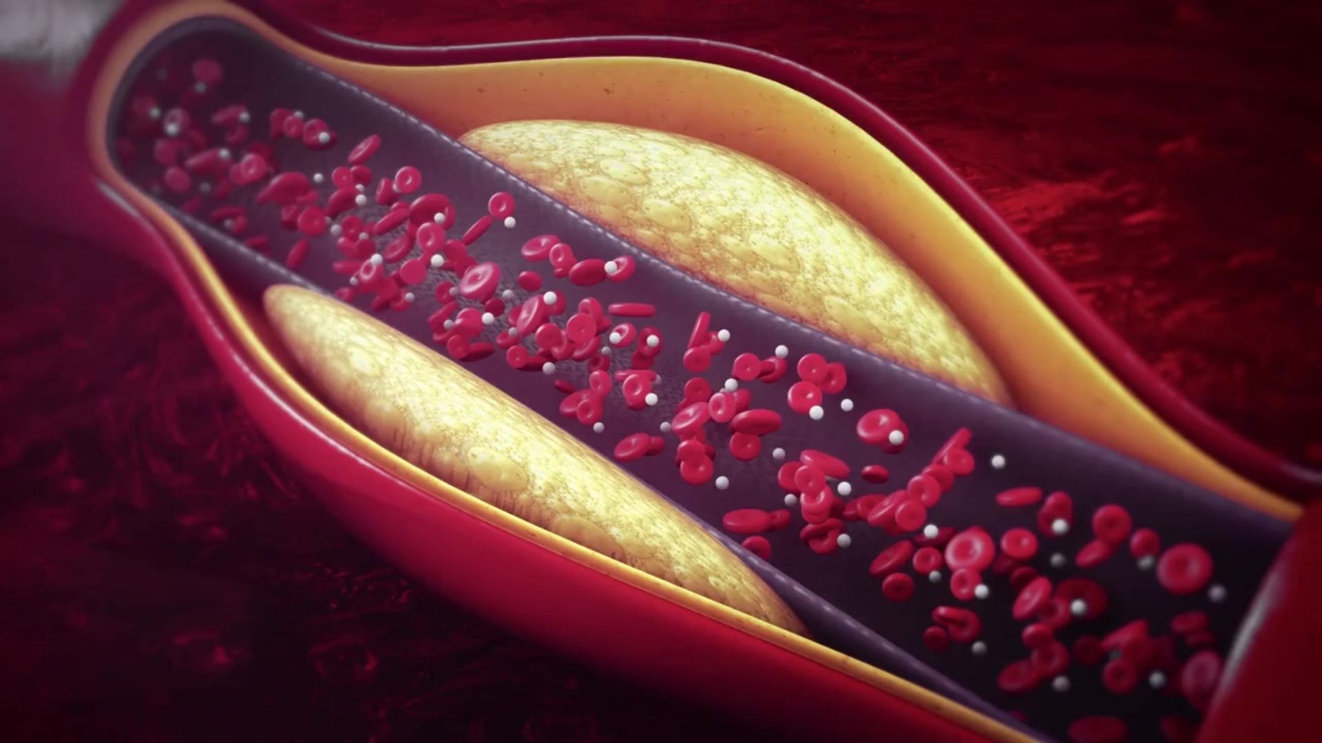 Rối loạn lipid máu có thể gây đột quỵ, làm thế nào để phòng ngừa?