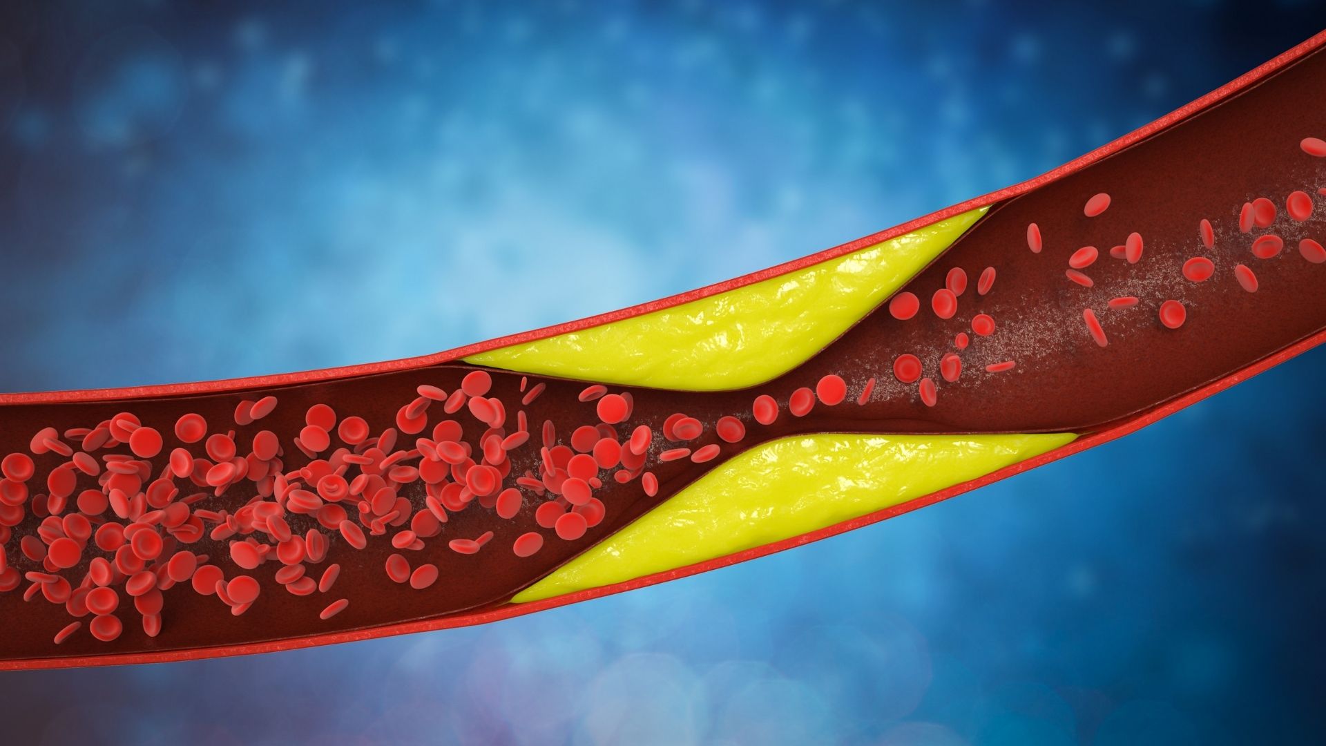 Đột quỵ do xơ vữa động mạch, làm thế nào để phòng ngừa?