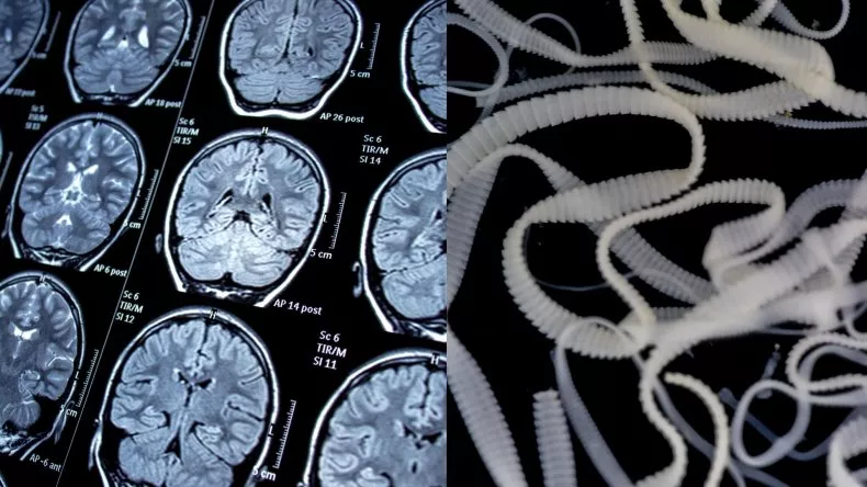 Thái Nguyên: Người đàn ông lên cơn co giật, tưởng đột quỵ, ngỡ ngàng là sán lợn làm tổ trong não