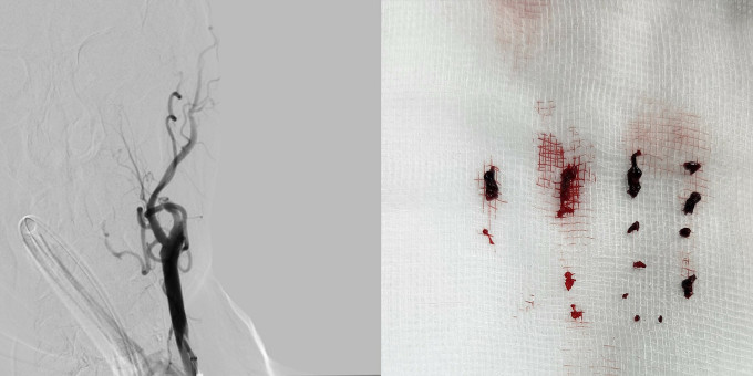 TPHCM: Người đàn ông 64 tuổi đột quỵ do có hơn 10 cục máu đông trong não