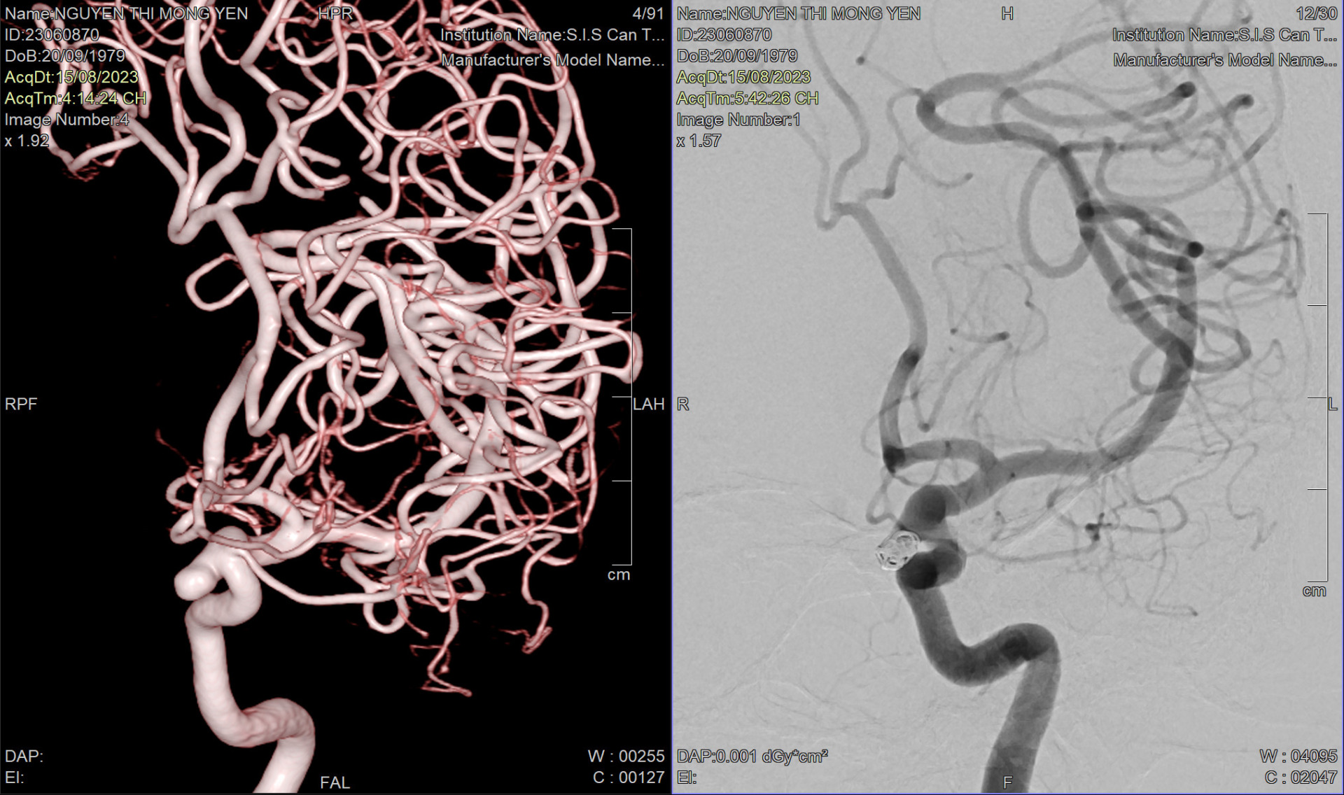 Bệnh viện S.I.S Cần Thơ can thiệp thành công ca bệnh túi phình kèm bệnh lý giảm tiểu cầu với chi phí chưa tới 100 triệu đồng
