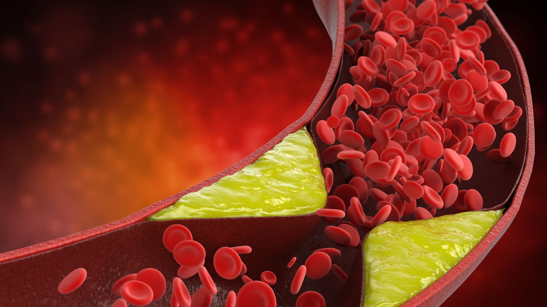 Nhồi máu não do xơ vữa động mạch cảnh