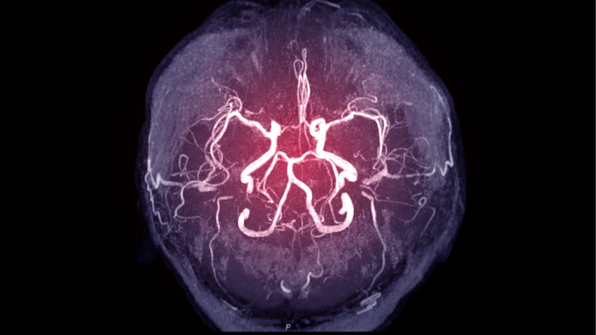 Người bệnh từng mang túi phình liệu có nguy cơ xuất hiện túi mới?