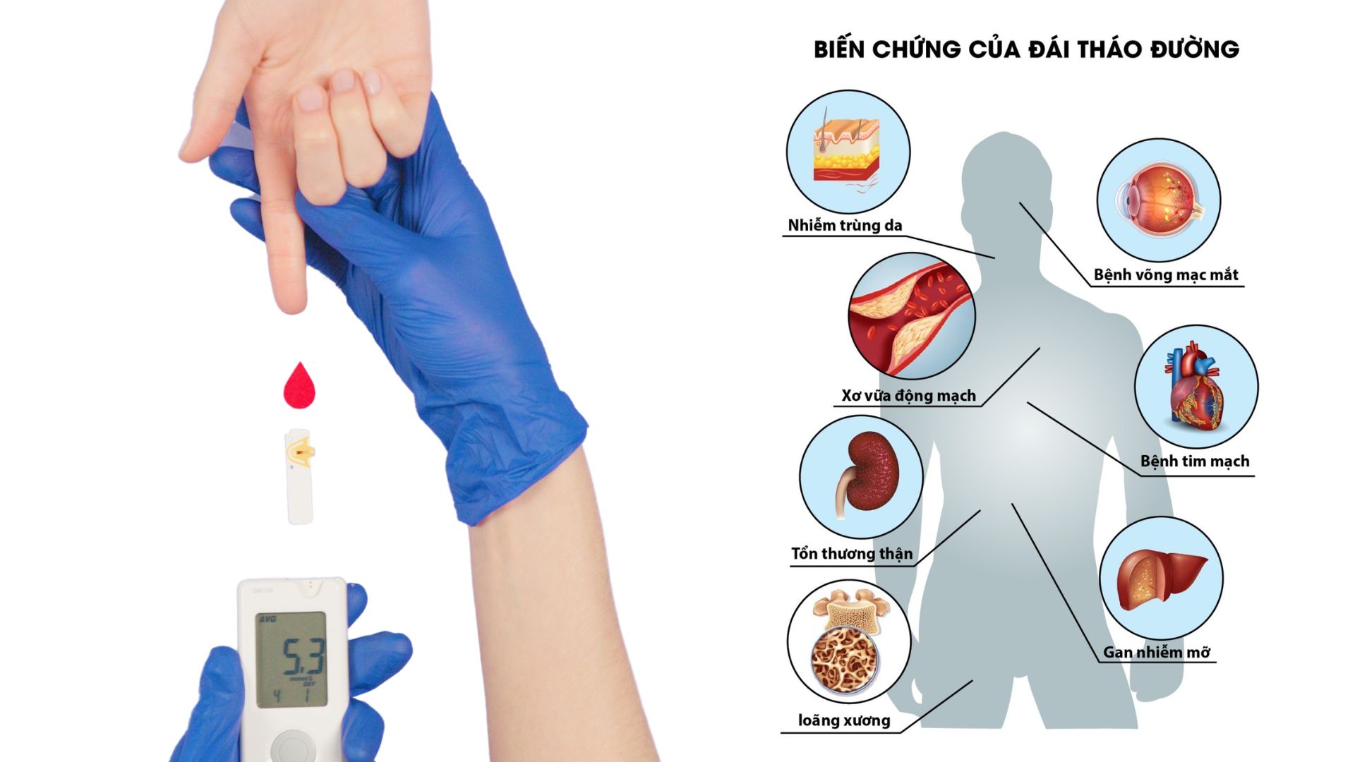 Biến chứng đáng sợ của bệnh tiểu đường