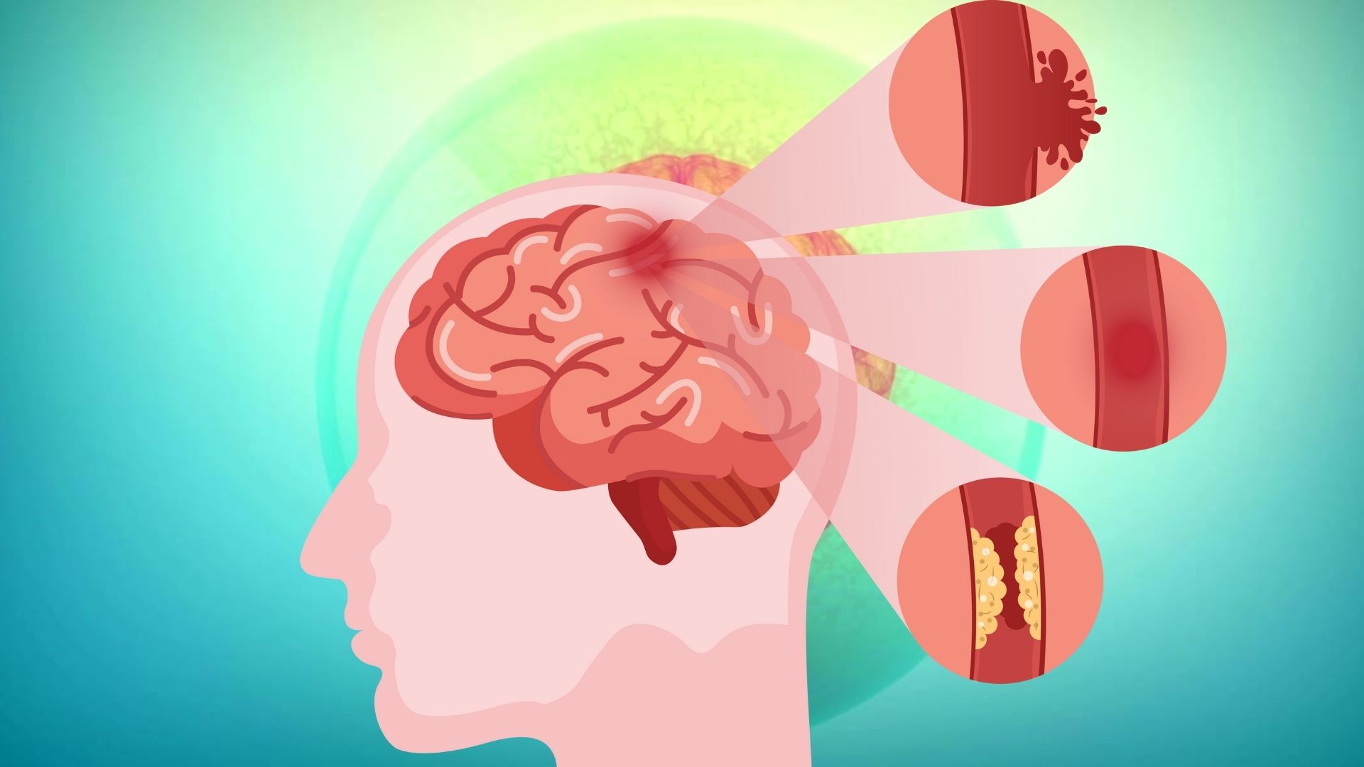 Cấp cứu kịp thời ngư dân bị đột quỵ xuất huyết não