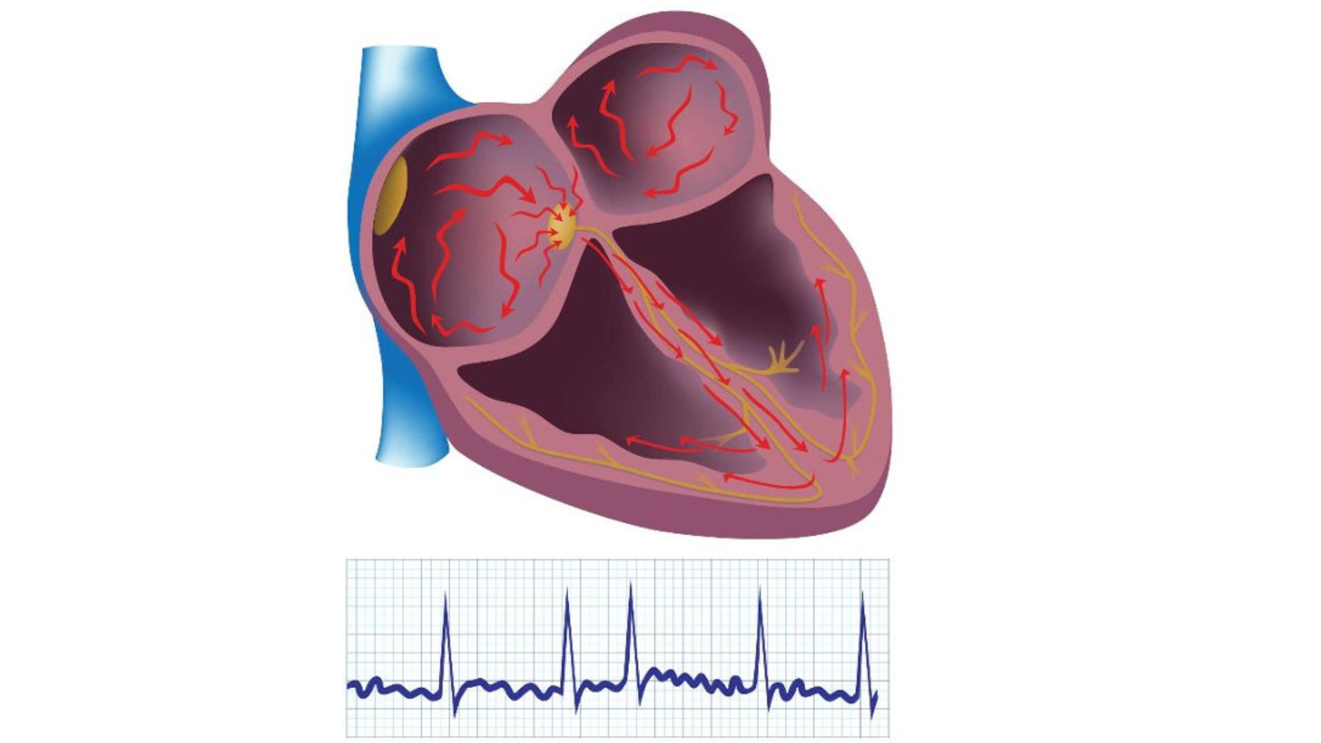 Chủ quan với triệu chứng của rung nhĩ, người đàn ông 61 tuổi bị bị nhồi máu não diện rộng