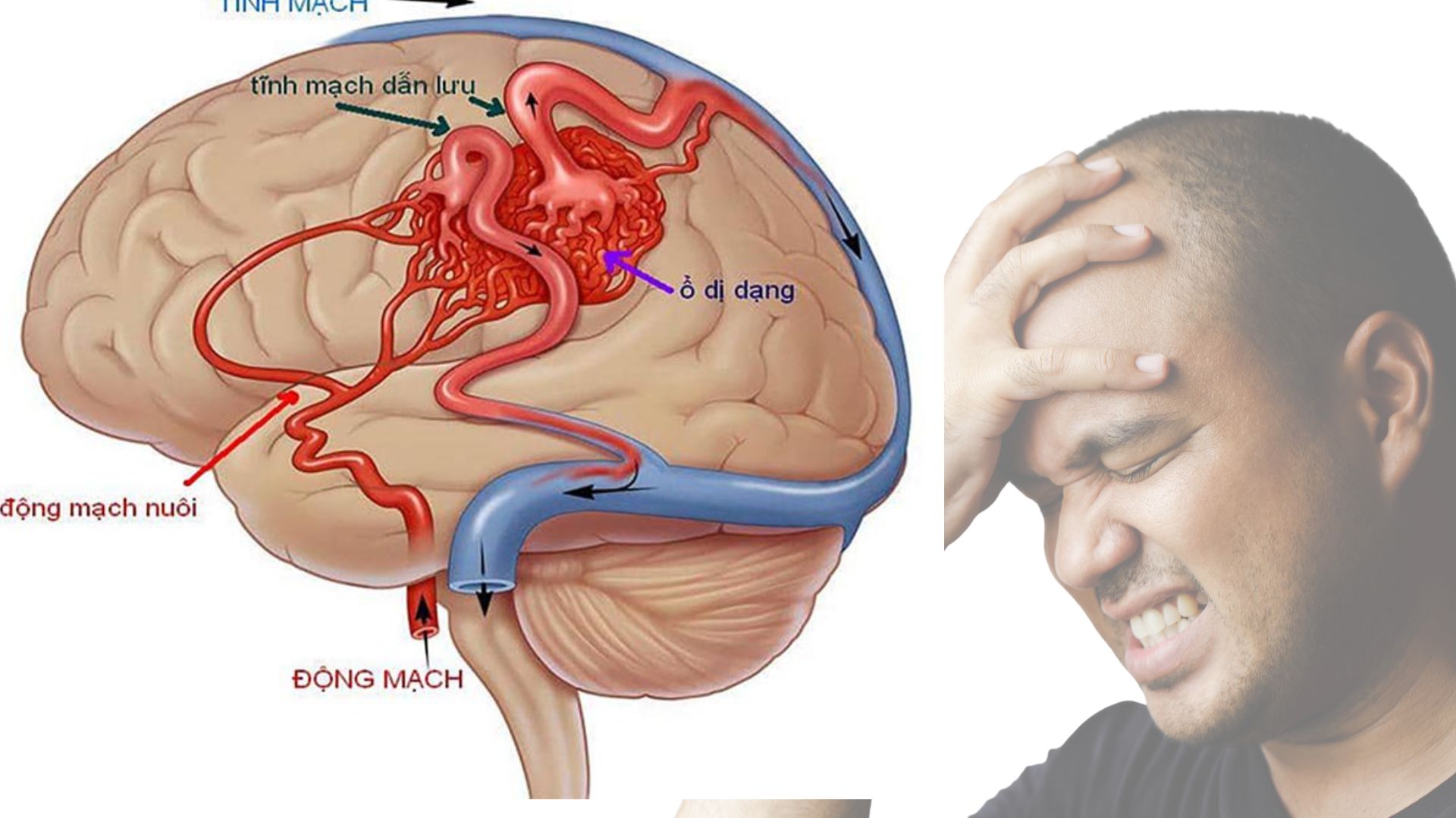 Dị dạng động tĩnh mạch não: “Quả bom nổ chậm” gây đột quỵ xuất huyết não