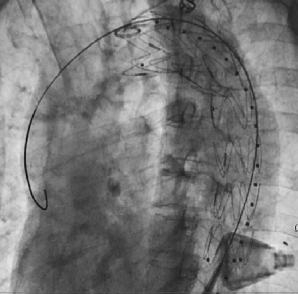 Phú Thọ: Đặt Stent Graft thành công cho bệnh nhân bị phình tách động mạch chủ