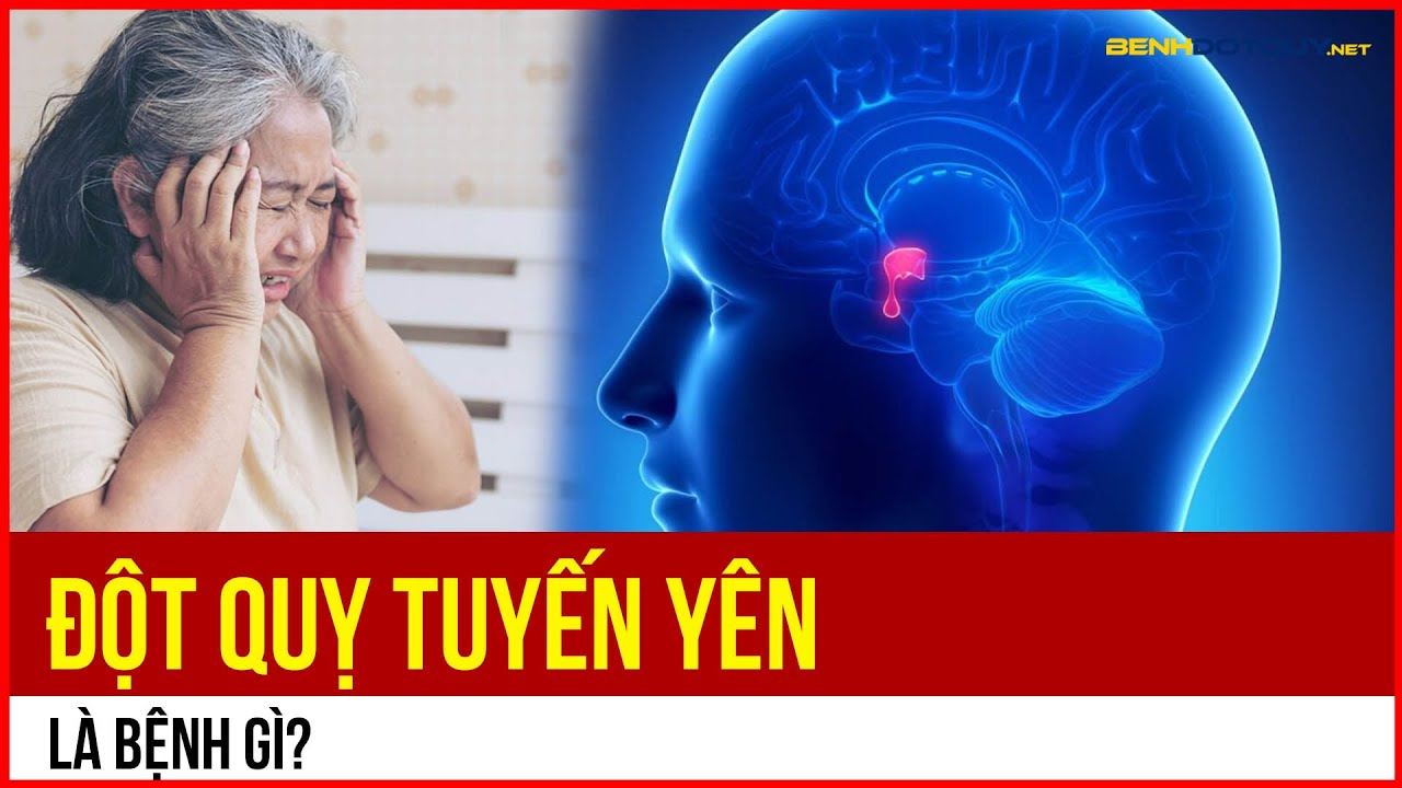 Đột quỵ Tuyến yên là bệnh gì?