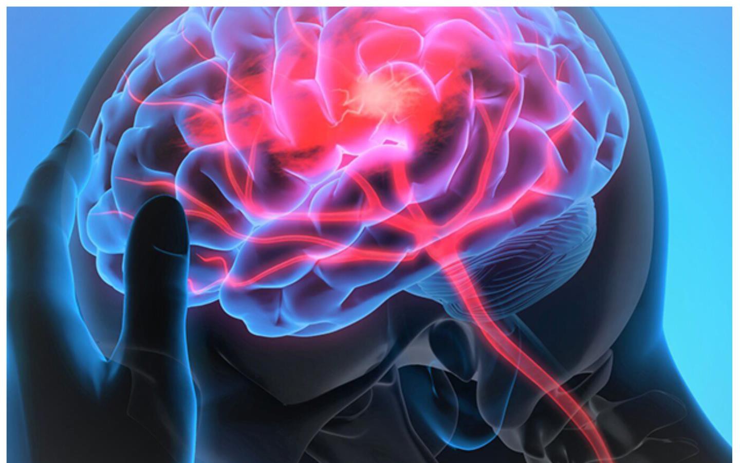 3 lần bị đột quỵ, làm sao để không tái phát?