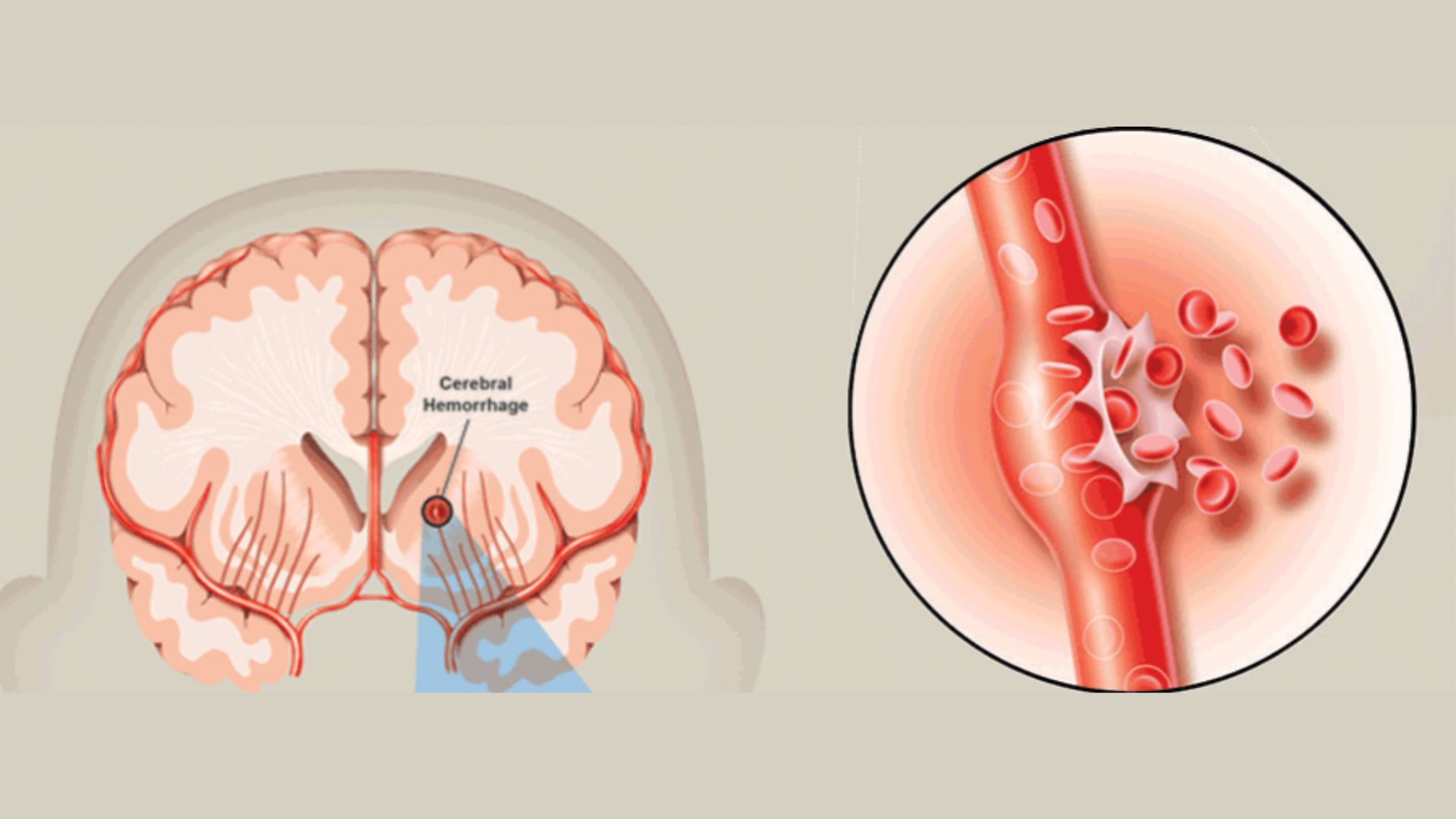 Nhồi máu não lỗ khuyết – Hội chứng của đột quỵ nhồi máu não