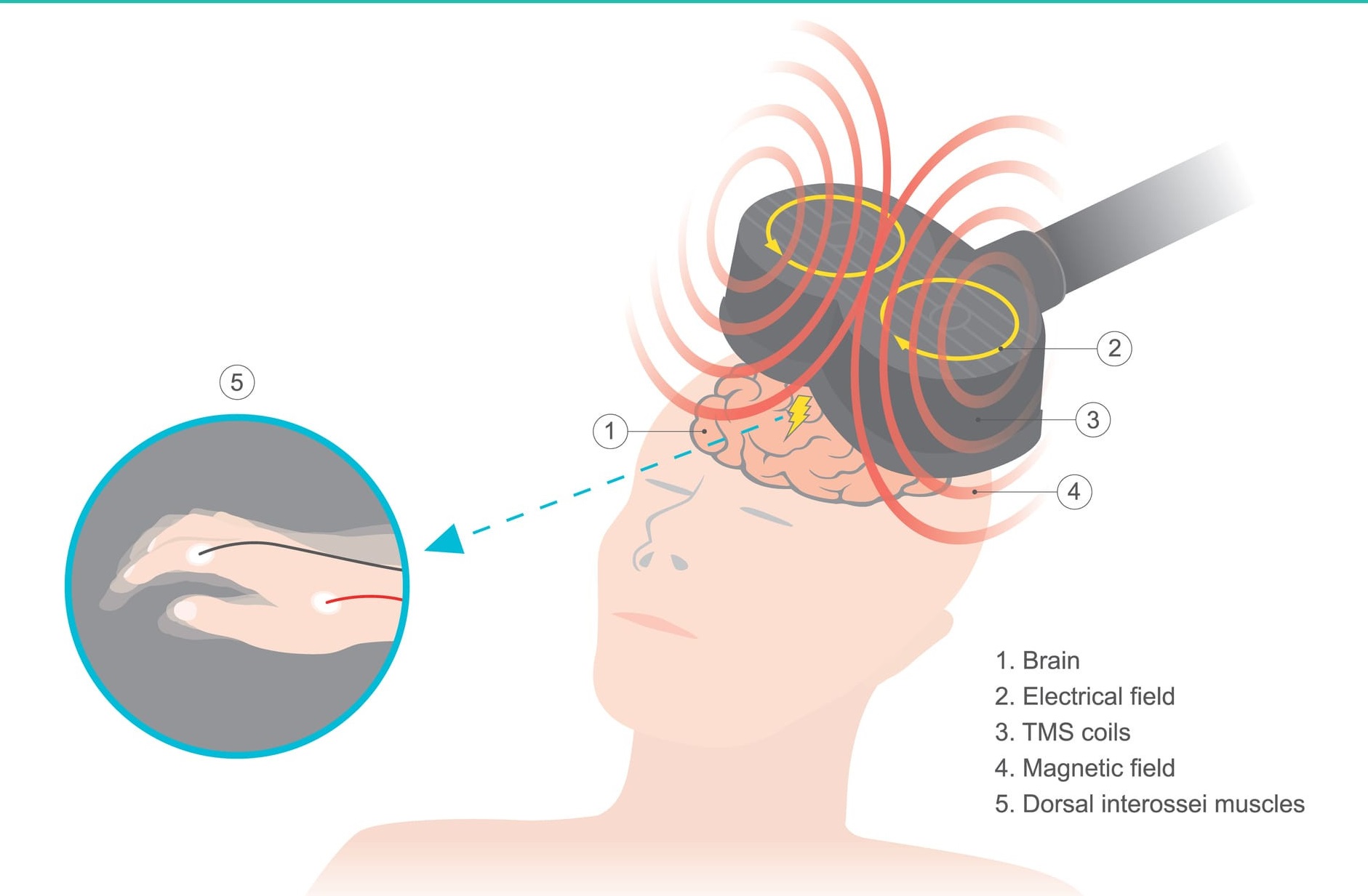 Phương pháp mới cho người mắc bệnh lý thần kinh