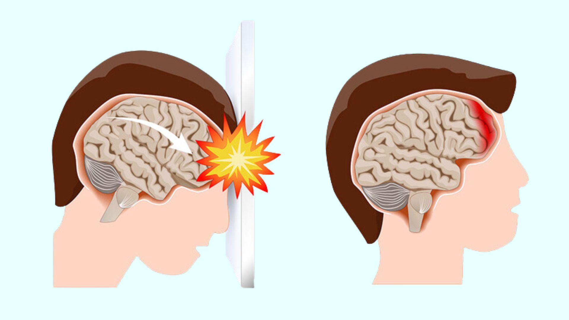 Rủi ro về đột quỵ nếu bị chấn thương vùng đầu