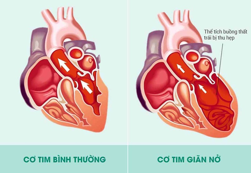 Cơ tim giãn hình thành cục máu đông gây đột quỵ nhồi máu não