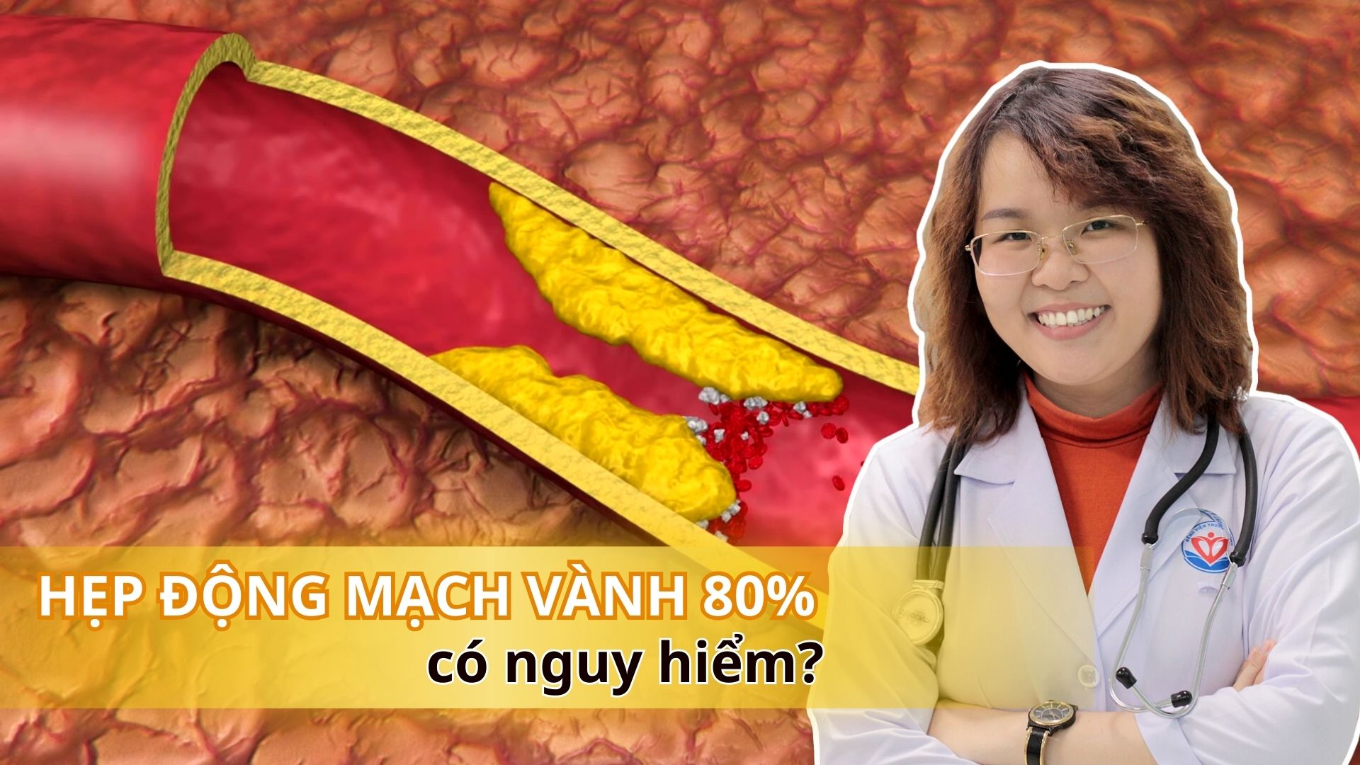 Hẹp động mạch vành 80% liệu có nguy hiểm?