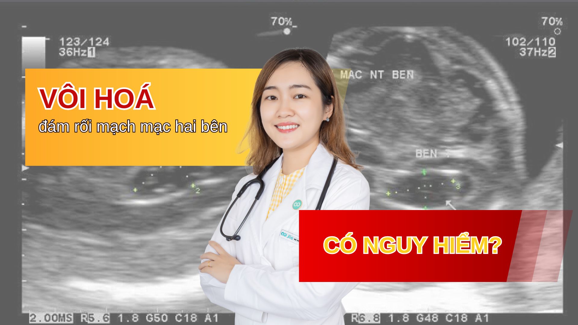 Vôi hóa đám rối mạch mạc hai bên có nguy hiểm?