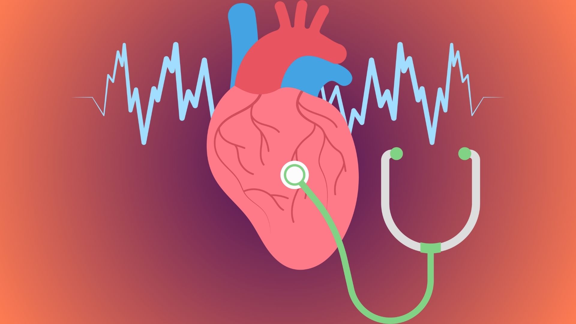U nhầy nhĩ trái gây biến chứng đột quỵ nhồi máu não
