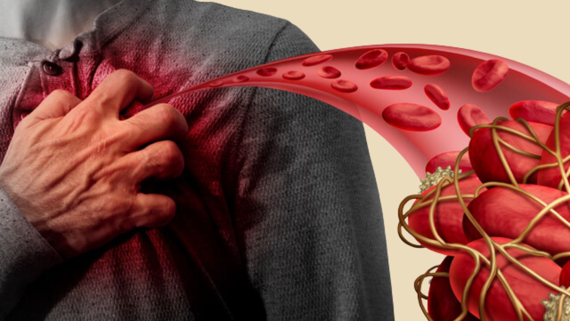 Đột quỵ do cục máu đông hình thành từ tim