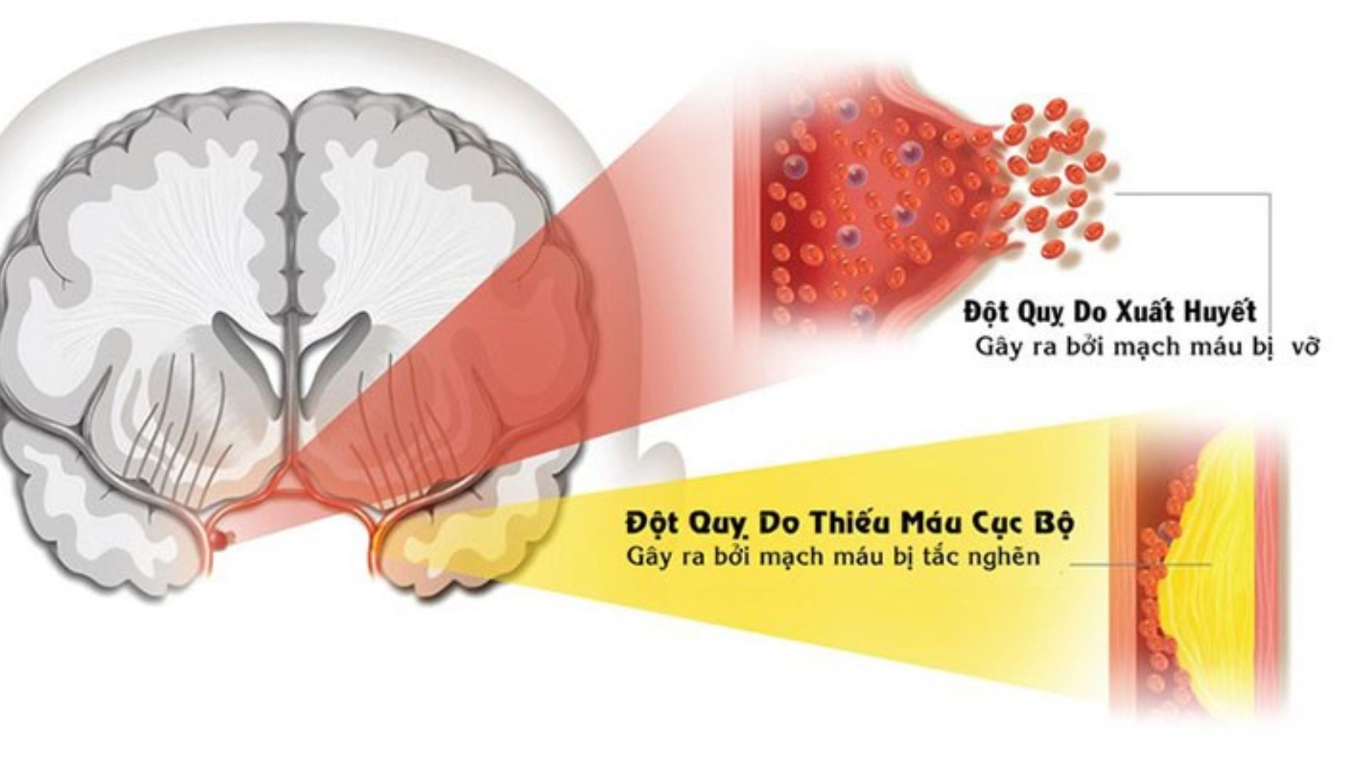 Đột quỵ liệu có thể chữa khỏi?