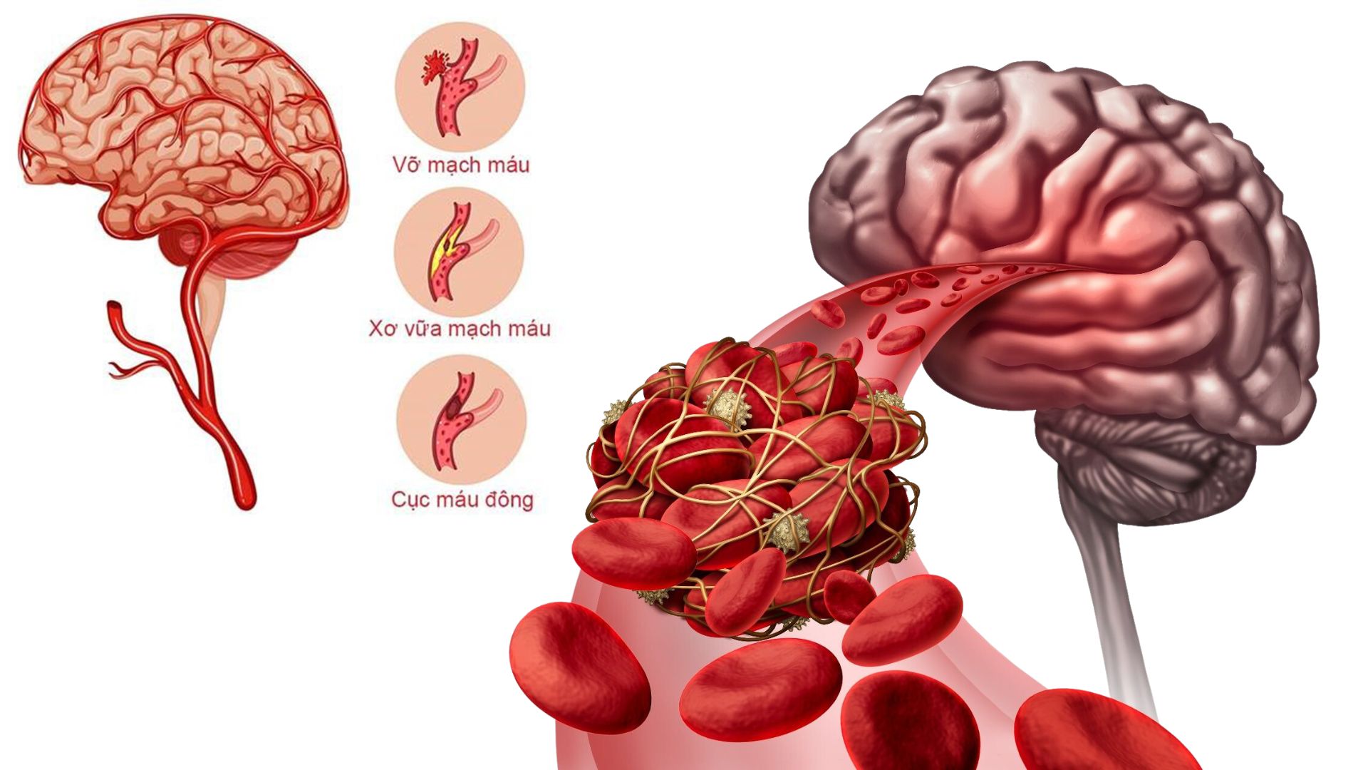 Việt Nam có 7,6% số ca đột quỵ là người trẻ dưới 45 tuổi