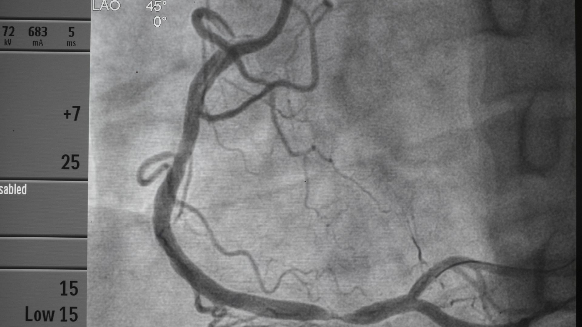 Ở TPHCM chụp mạch vành tại bệnh viện nào?