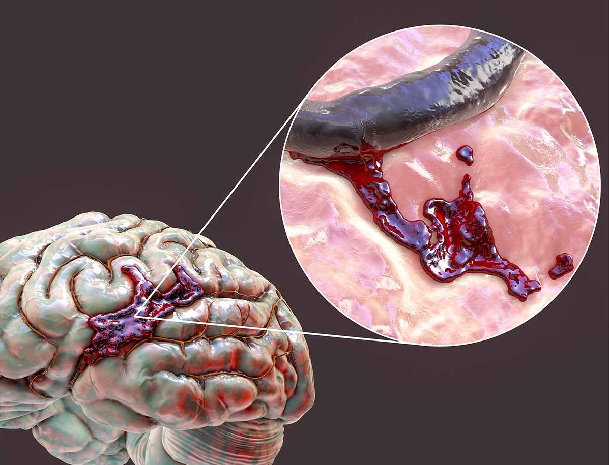 Tê liệt nửa người sau xuất huyết não, làm sao để cải thiện?