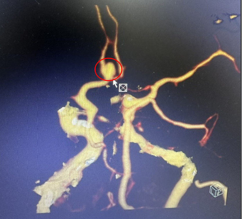 TPHCM: Cấp cứu thành công nữ bệnh nhân 67 tuổi đột quỵ do vỡ túi phình
