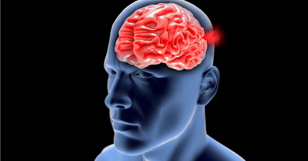 Vỡ phình máu não điều trị như thế nào?